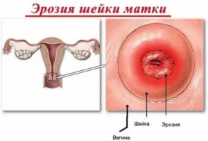 Диагностика эрозии шейки матки девственниц