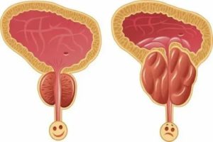 Легкое покалывание в простате