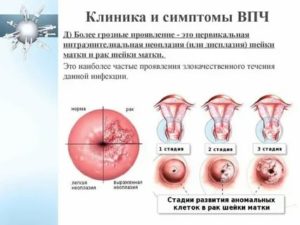 Можно ли заразиться от больного раком рак шейки матки