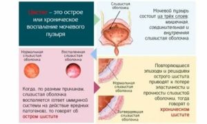 Почему не проходит острый цистит