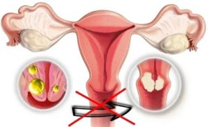 Может ли сама рассосаться киста шейки матки что это такое