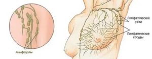 Как остановить лимфу после операции на молочной железе