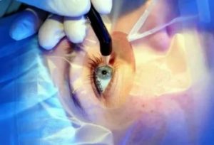 Можно ли делать операцию по коррекции зрения во время месячных
