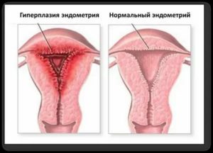Как уменьшить эндометрий при менопаузе народными средствами