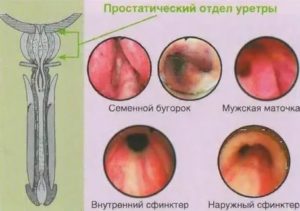 Диагностика воспаления семенного бугорка