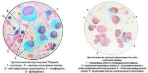 Цитологическая картина карциномы молочной железы