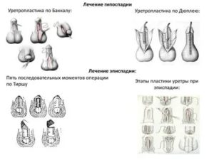 Как делают операции мошоночной гипоспадии