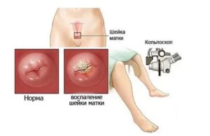 Кольпоскопия может выявить молочницу
