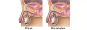 Что делать если после операции варикоцеле увеличилось яичко