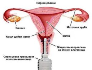 Можно ли во время месячных спринцеваться хлоргексидином в