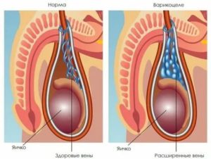 Опухоль яичка после операции на варикоцеле
