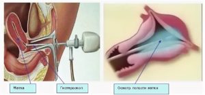 Раздельное диагностическое выскабливание при эндометриозе