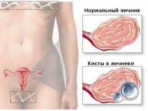 Как запустить яичники после операции