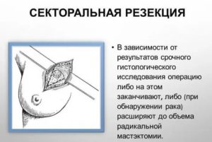 Что такое местная анестезия при операции на молочной железе