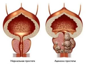 Йодная сетка при аденоме простаты