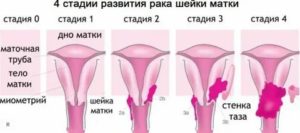 Как проходят месячные при раке шейки матки