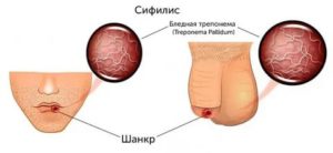 Как выглядит мягкий шанкр у женщин