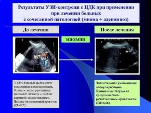 Васкуляризация матки на узи