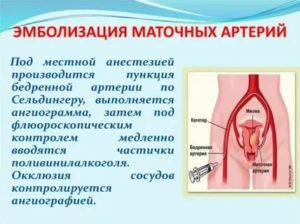 Эмболизация маточных артерий при раке шейки матки как делать