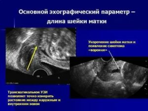 Узи биометрия шейки матки при беременности
