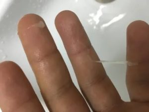 Слизь в сперме простатит