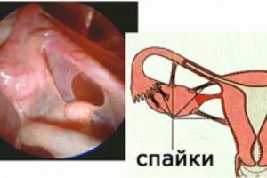 Как убрать спайки на маточных трубах без операции народные средства