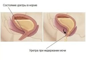 Недержание мочи при простатите и его лечение