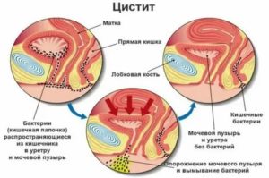 Что такое гематурический цистит