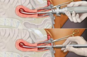Почему нет месячных после выскабливания замершей беременности