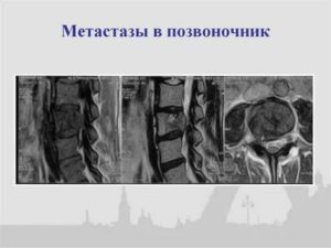 Как лечить метастазы в позвоночнике при раке молочной железы