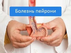 Можно ли вылечить болезнь пейрони без операции