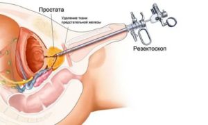 После лечения хронического простатита нет семяизвержения