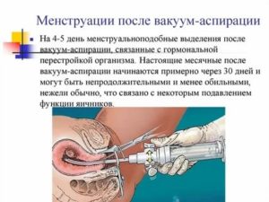 Почему нет месячных два месяца после выскабливания