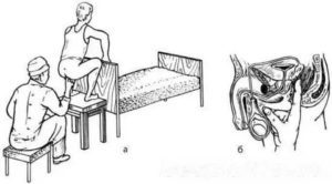 Как делают массаж простаты в санатории