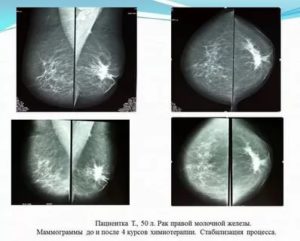 Когда можно делать маммографию после операции на молочной железе