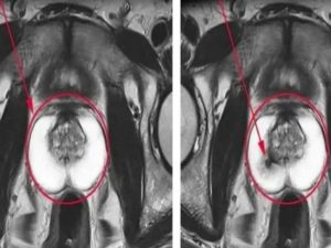 Мрт-признаки гиперплазии предстательной железы