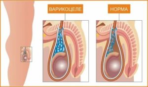 Что делать если после операции варикоцеле болит яичко у