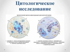 Цитологическая картина карциномы молочной железы