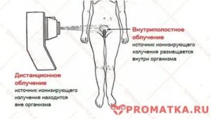 Как лечиться после лучевой терапии шейки матки