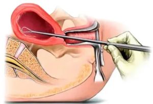 Диагностическое выскабливание полости матки от полипов или гистероскопия