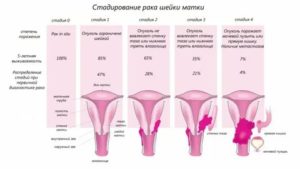 Как проходят месячные при раке шейки матки