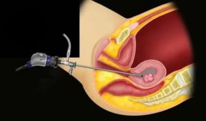 Сколько по времени делается гистероскопия эндометрия