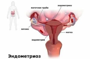 Может ли эндометриоз стать причиной замершей беременности