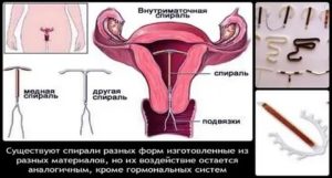 Плюсы и минусы гинекологической спирали