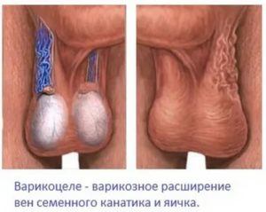 Как атрофируется яичко после операции