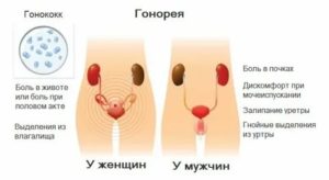 Что такое гонококки и чем их лечить у