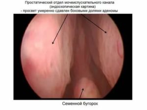 Диагностика воспаления семенного бугорка