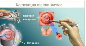 Сколько по времени делают операцию на шейки матки
