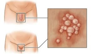 Почему обостряется герпес перед месячными