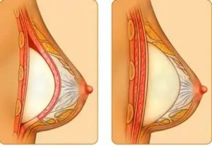 Как называется операция по увеличению молочных желез